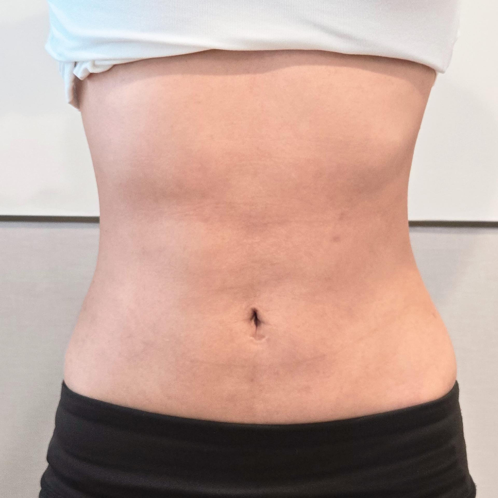 3 month after LAMS