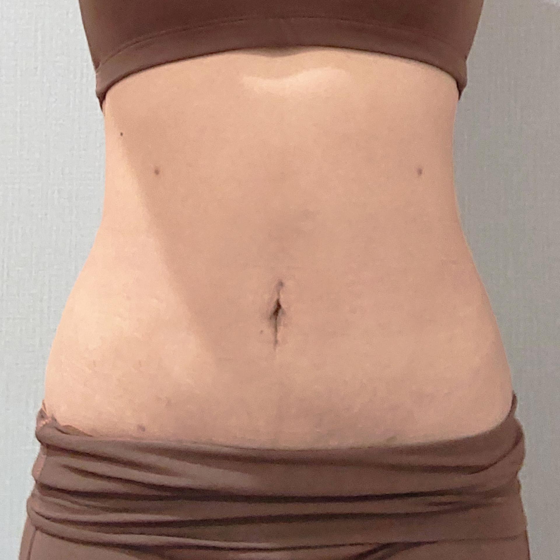 3 month after LAMS