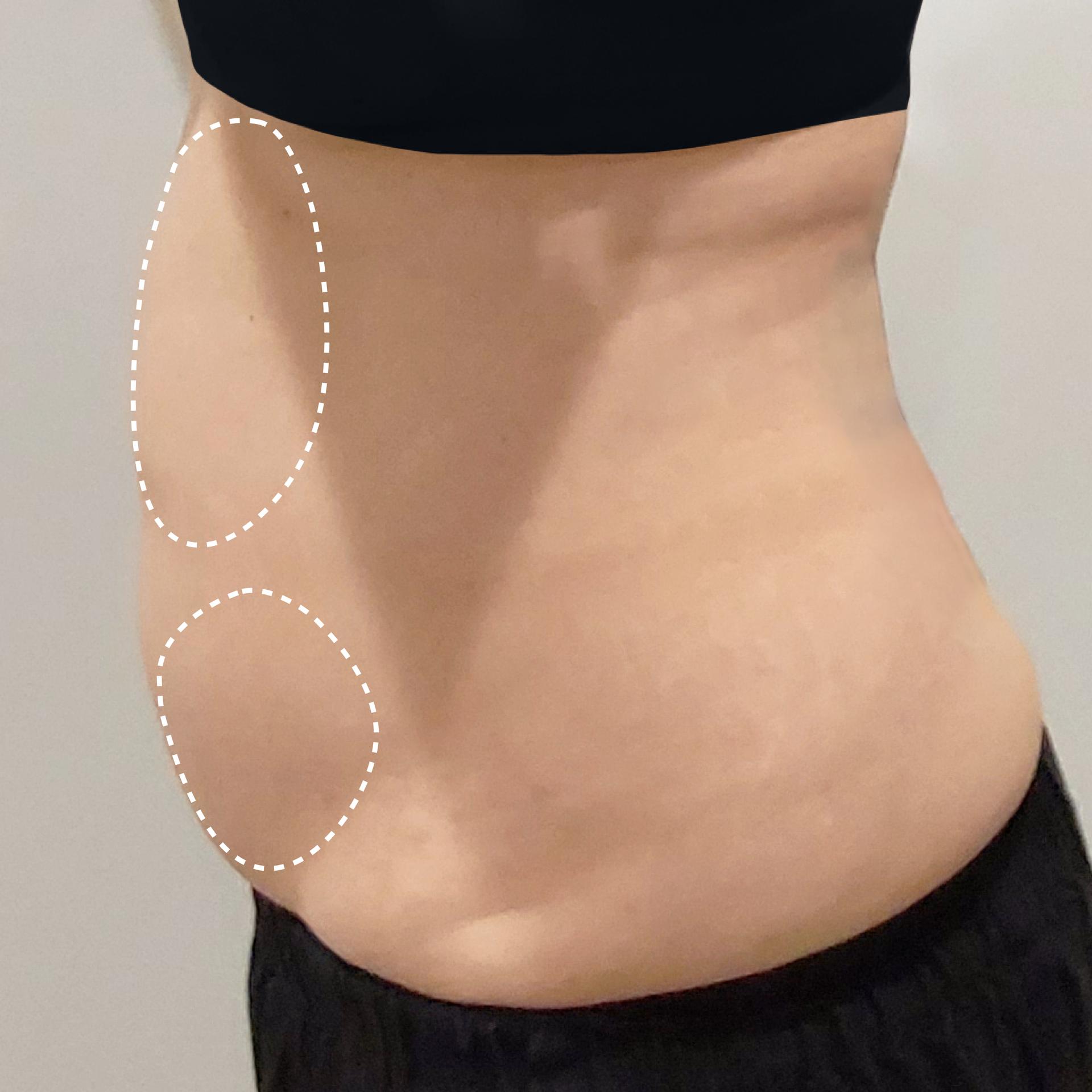 Before Abdomen LAMS