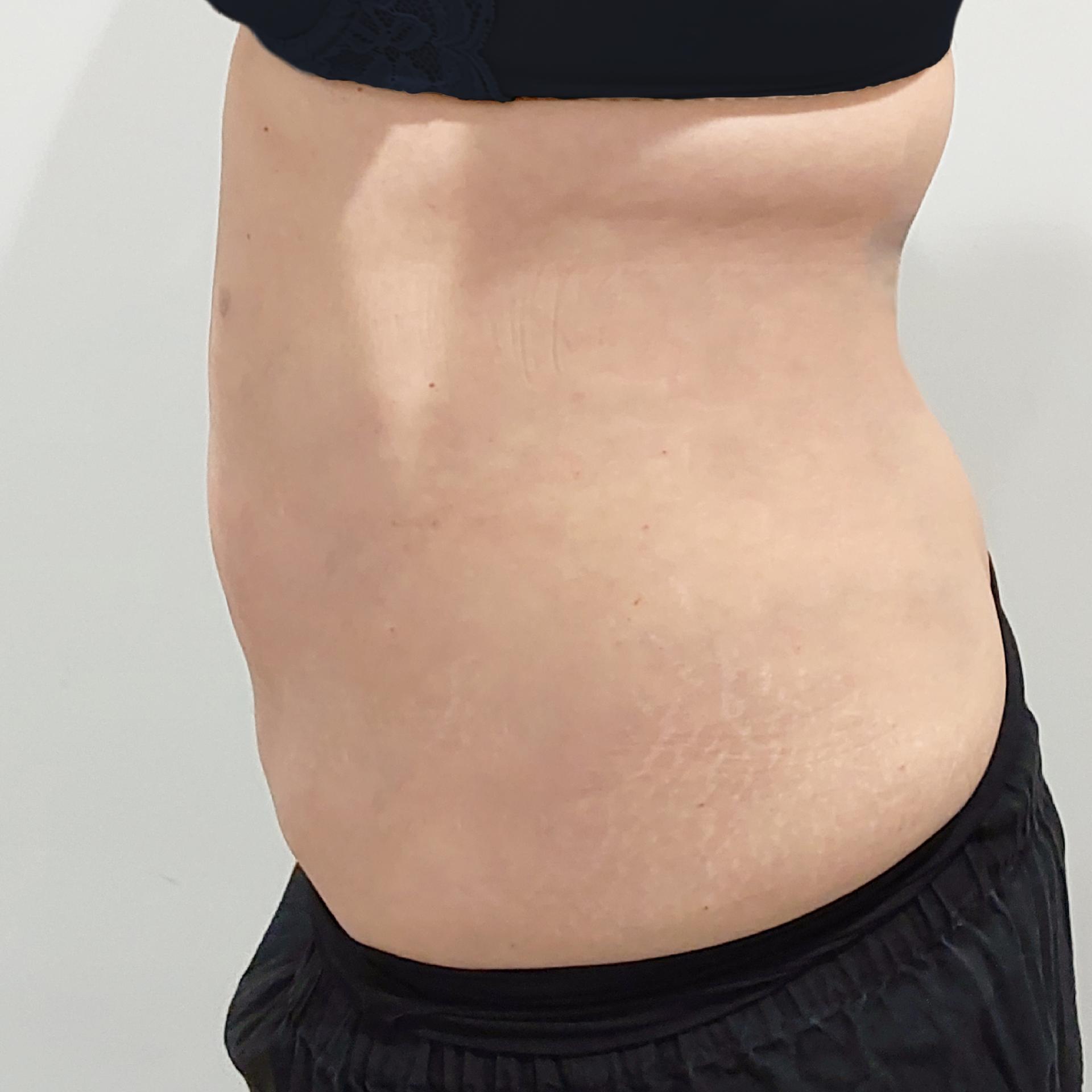 3 Months After Abdomen LAMS