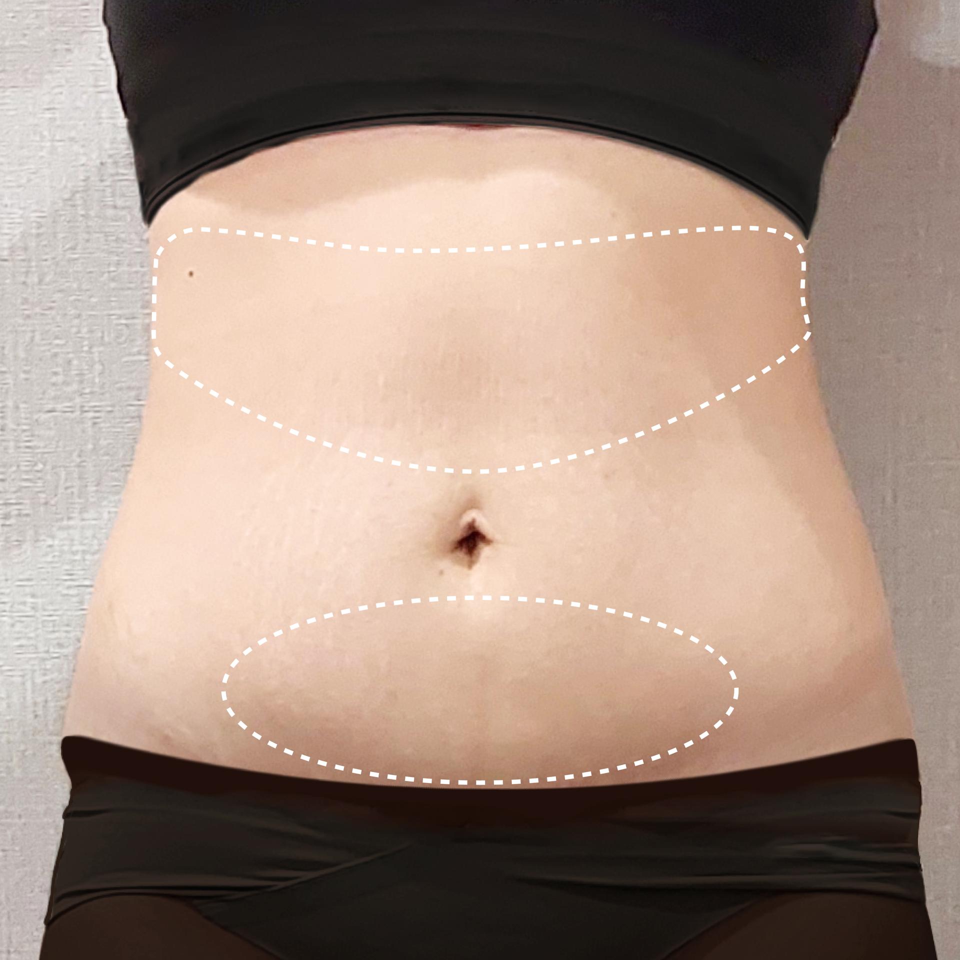 Before Abdomen LAMS