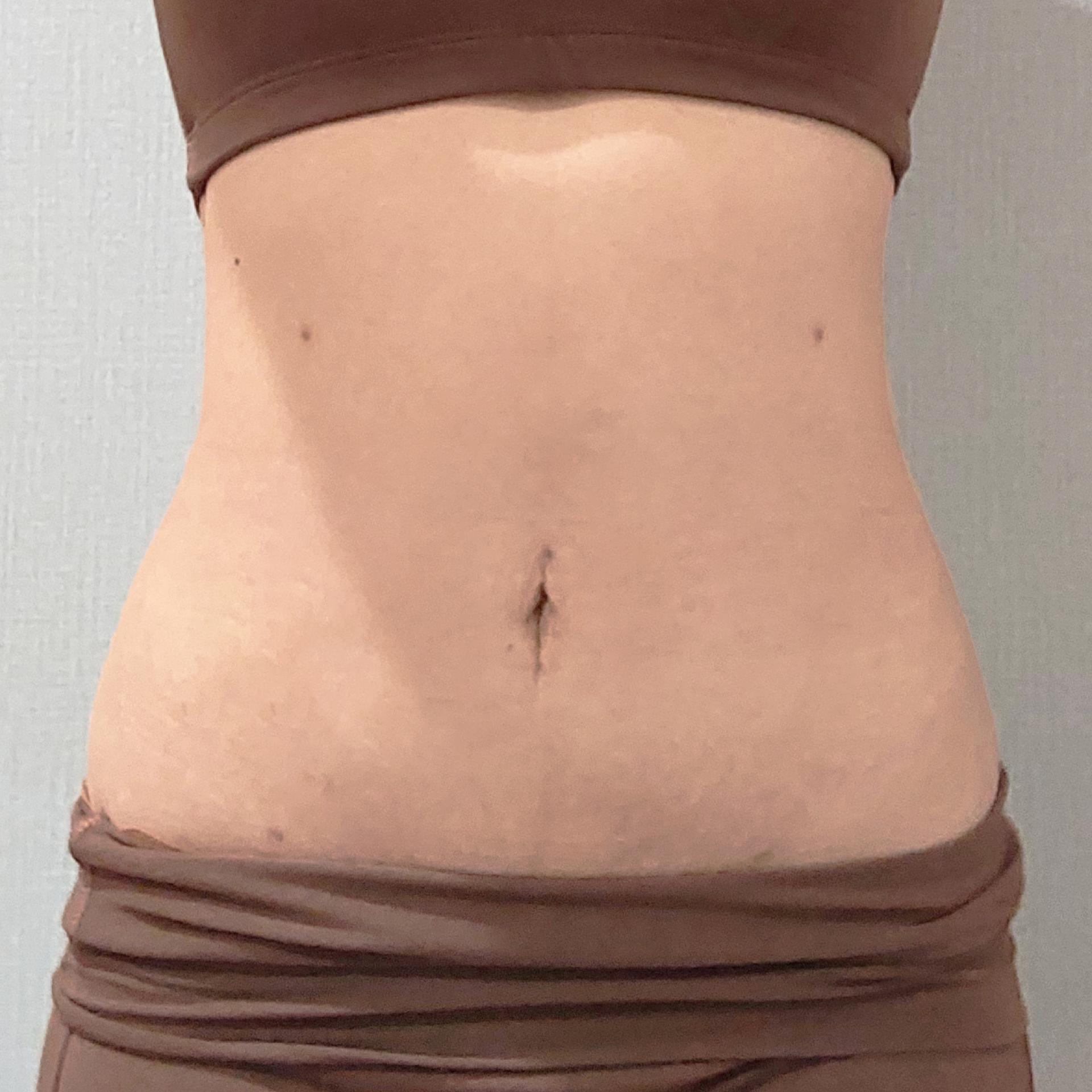 3 Months After Abdomen LAMS