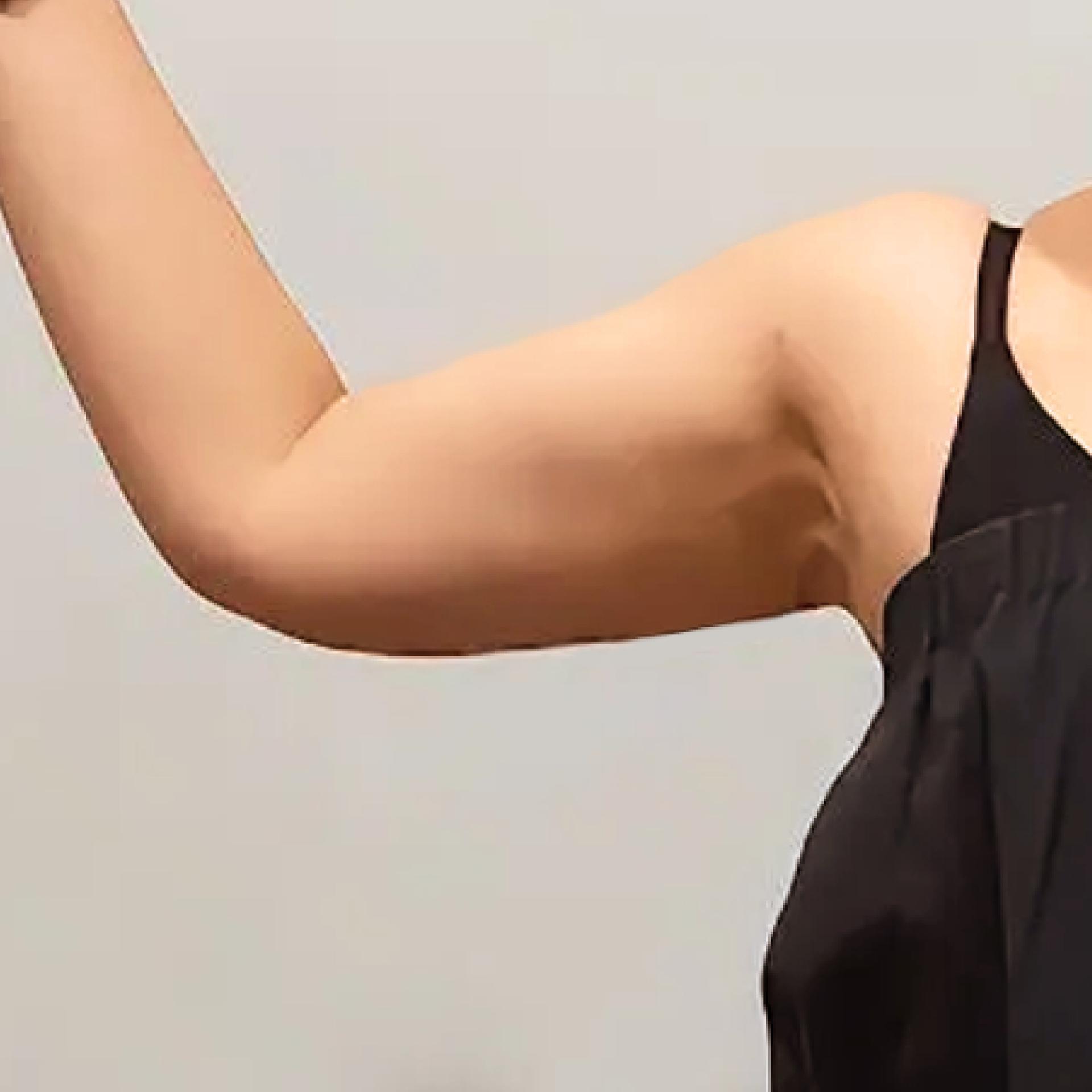 3 Months After LAMS Arms