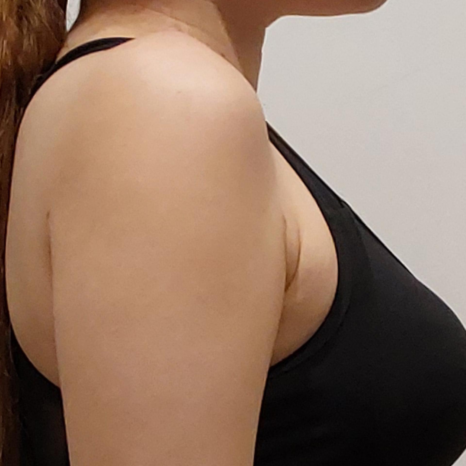 3 months after LAMS
