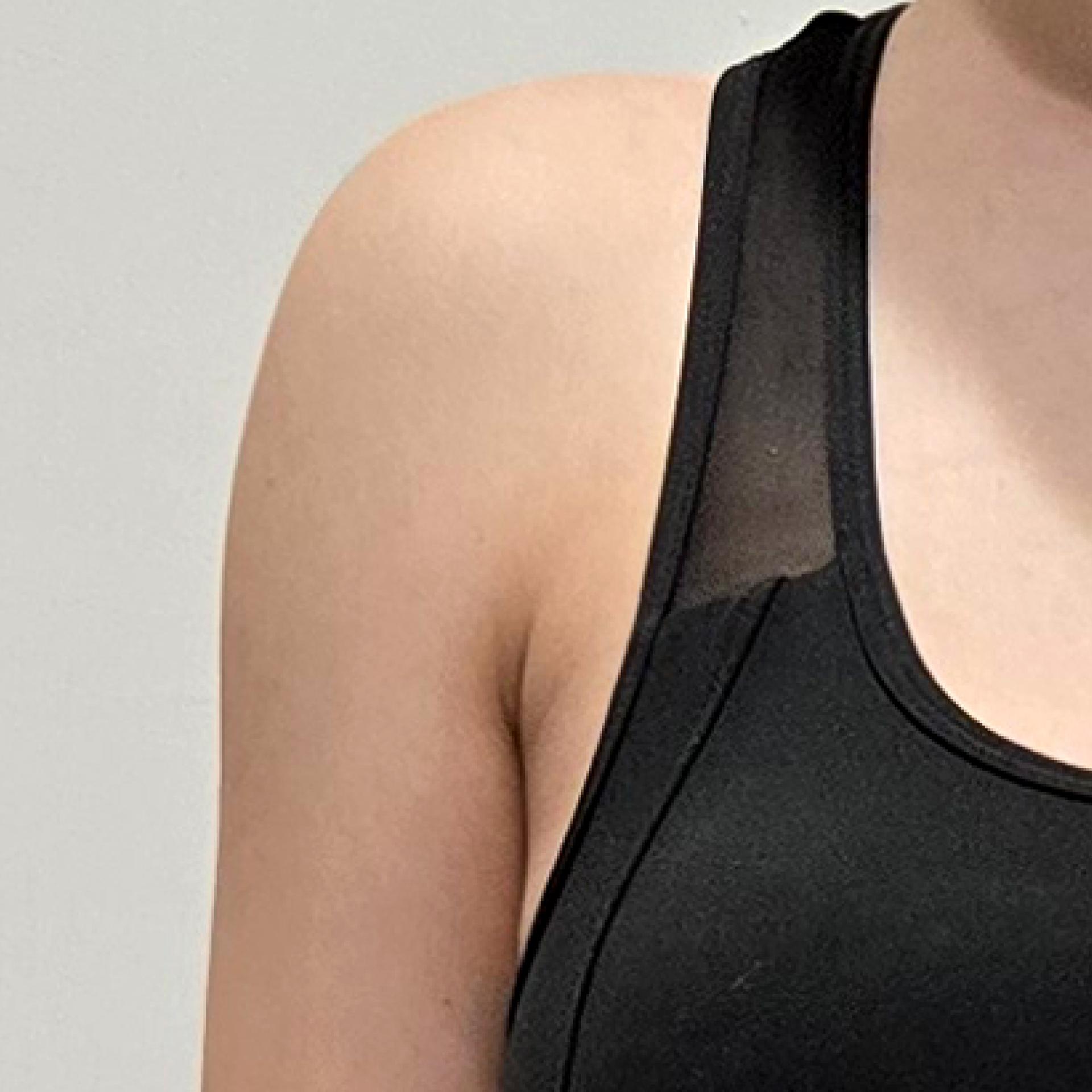 5 months after Armpit LAMS