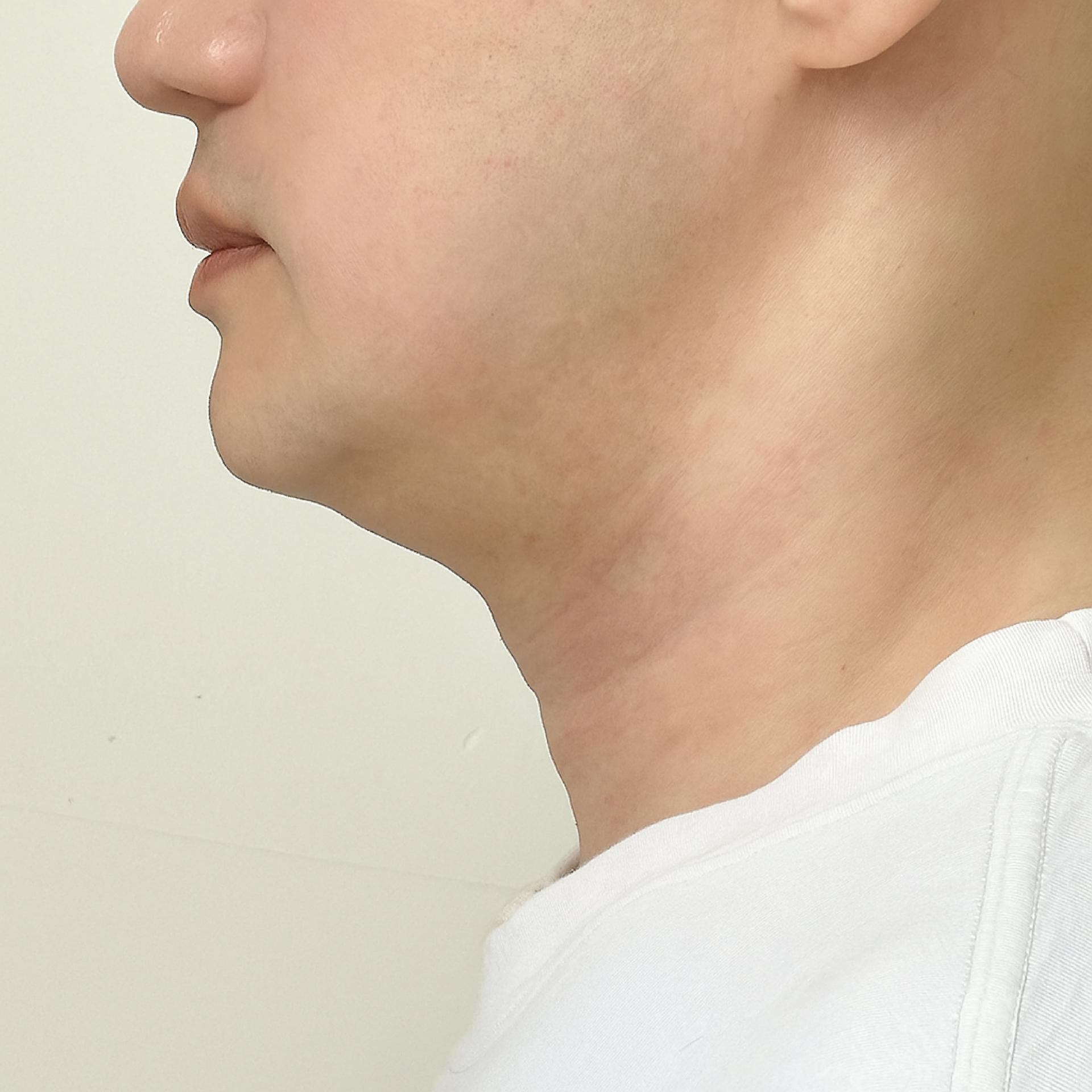 8 months after double chin LAMS