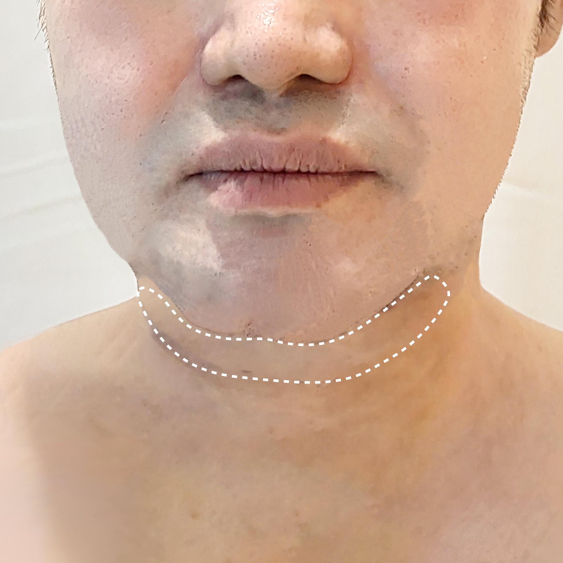 Before double chin LAMS