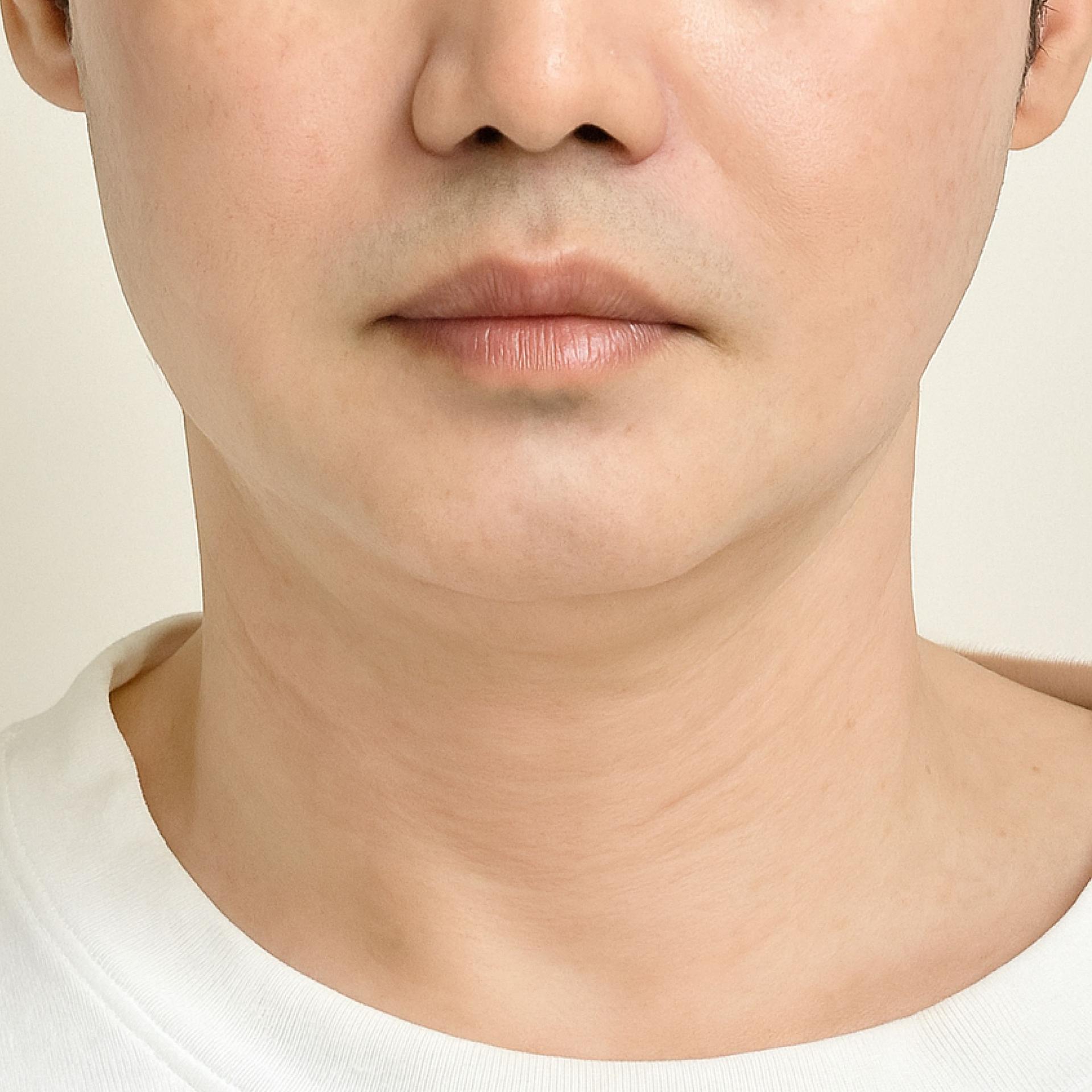 8 months after double chin LAMS