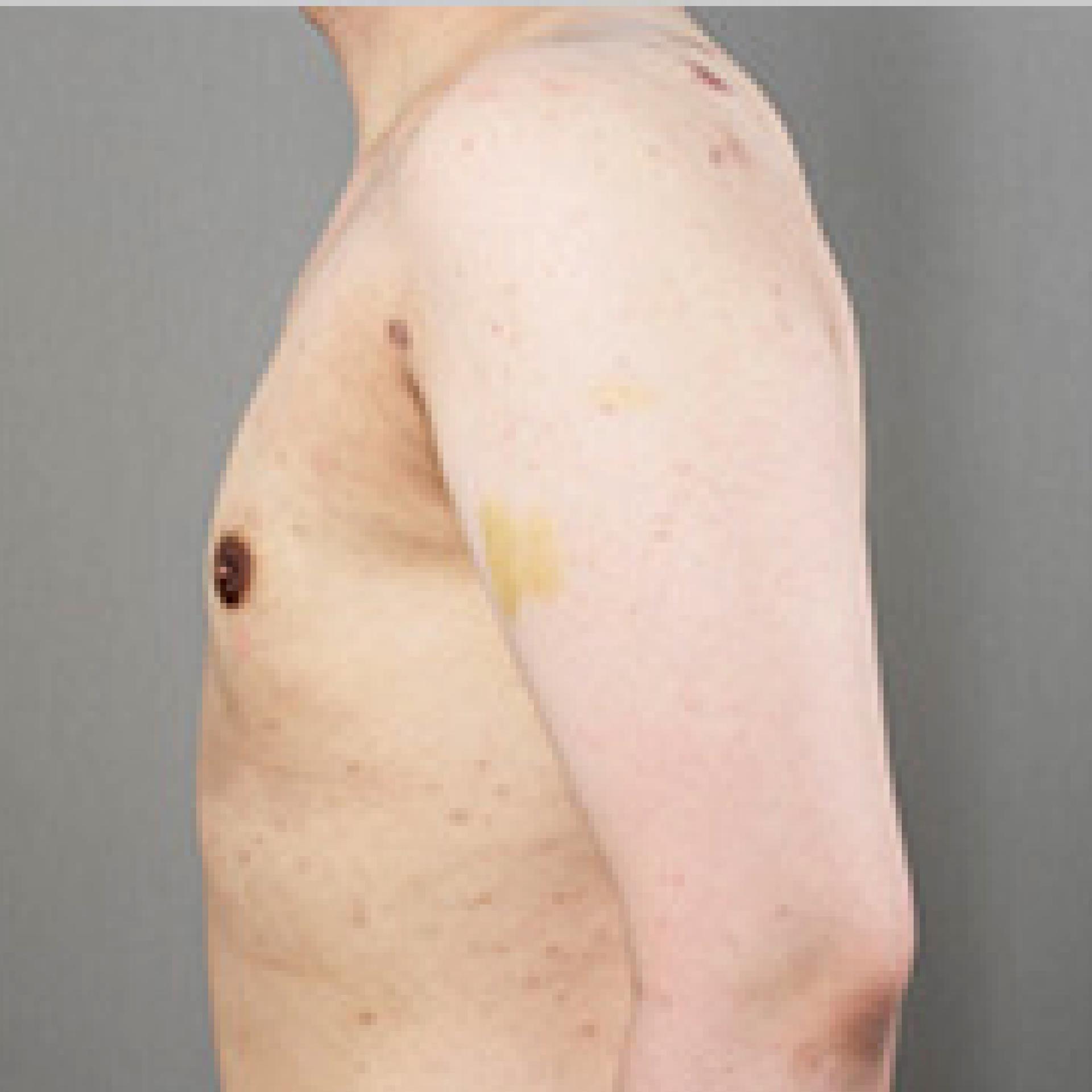 14 month after LAMS