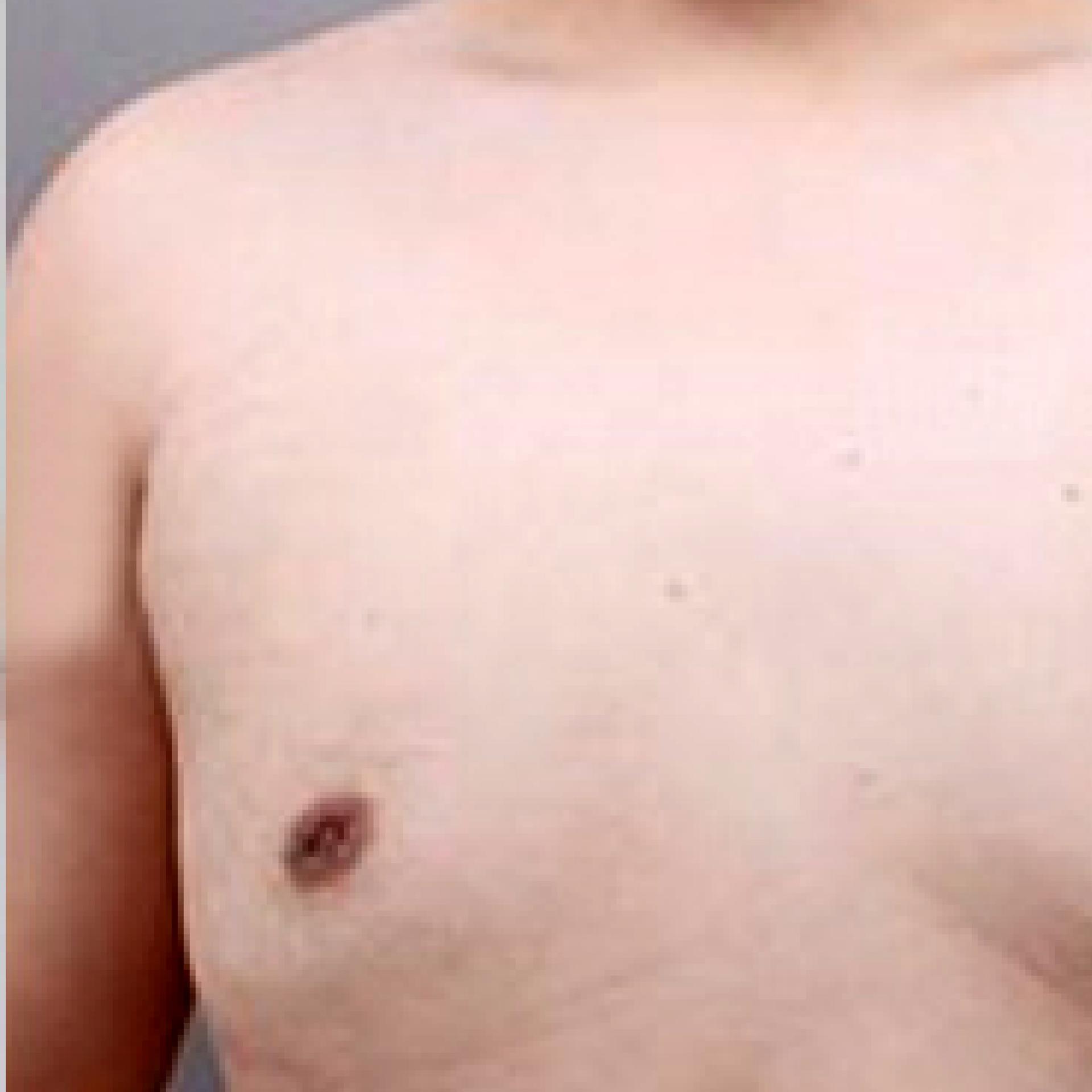 10 month after LAMS