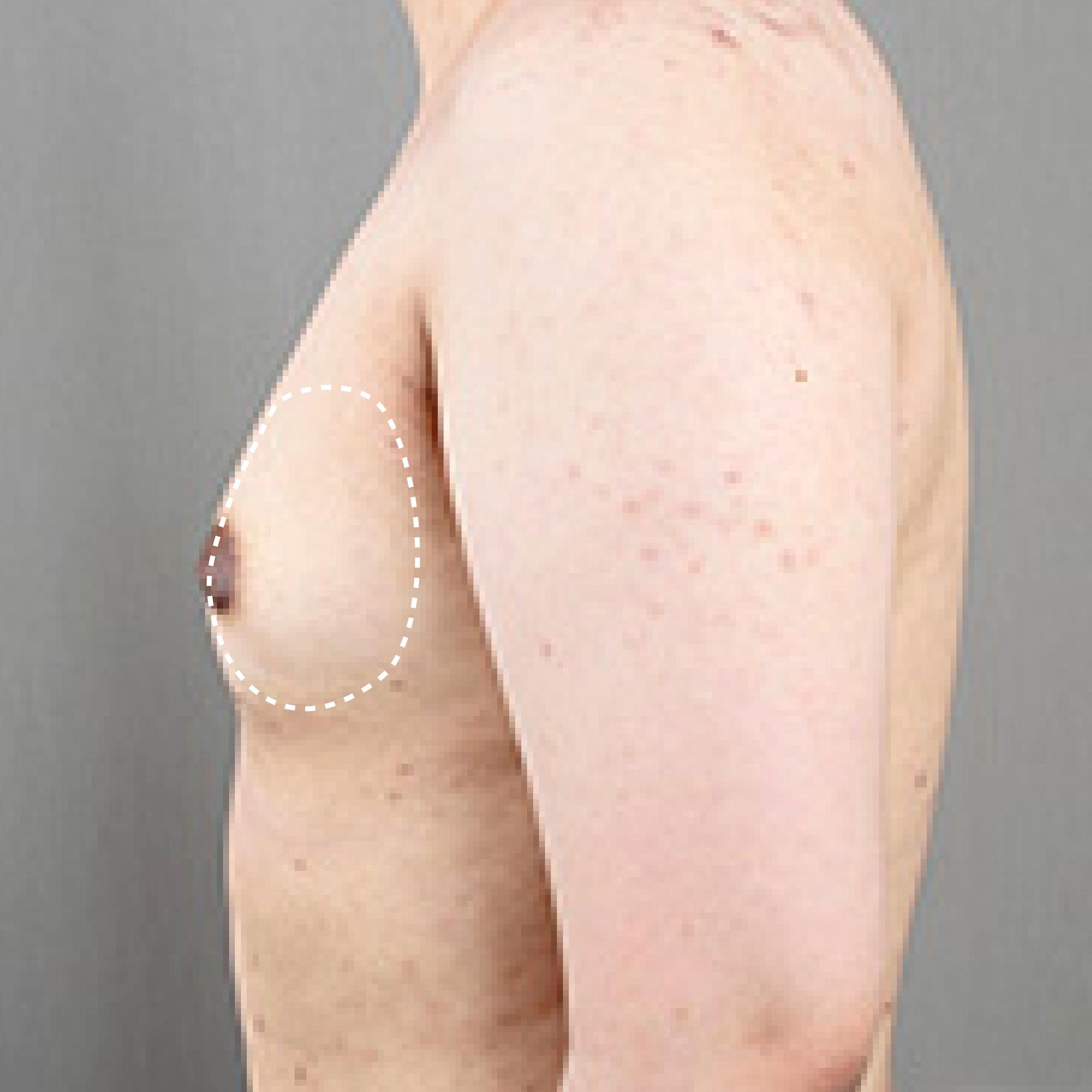 Before Gynecomastia LAMS