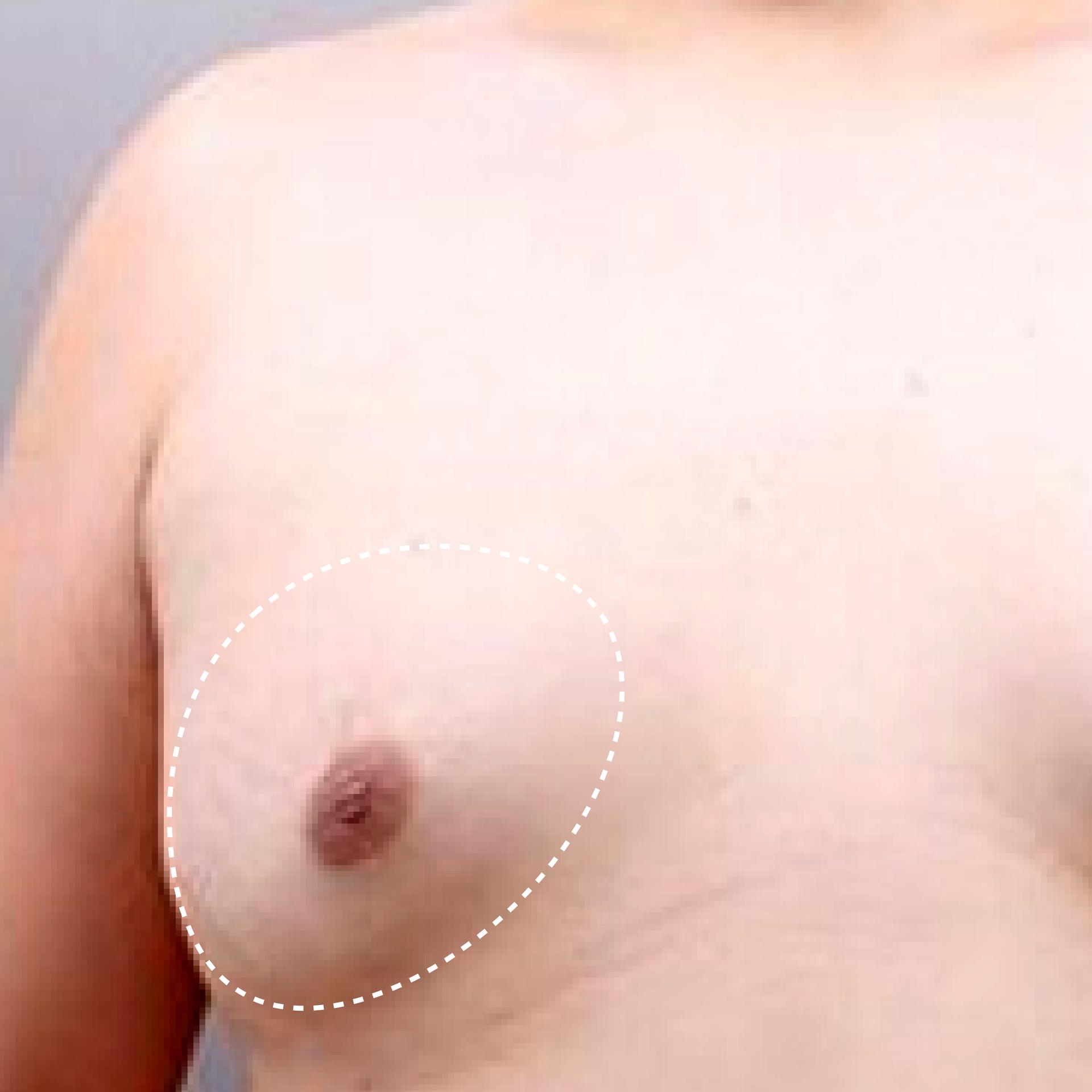 Before Gynecomastia LAMS
