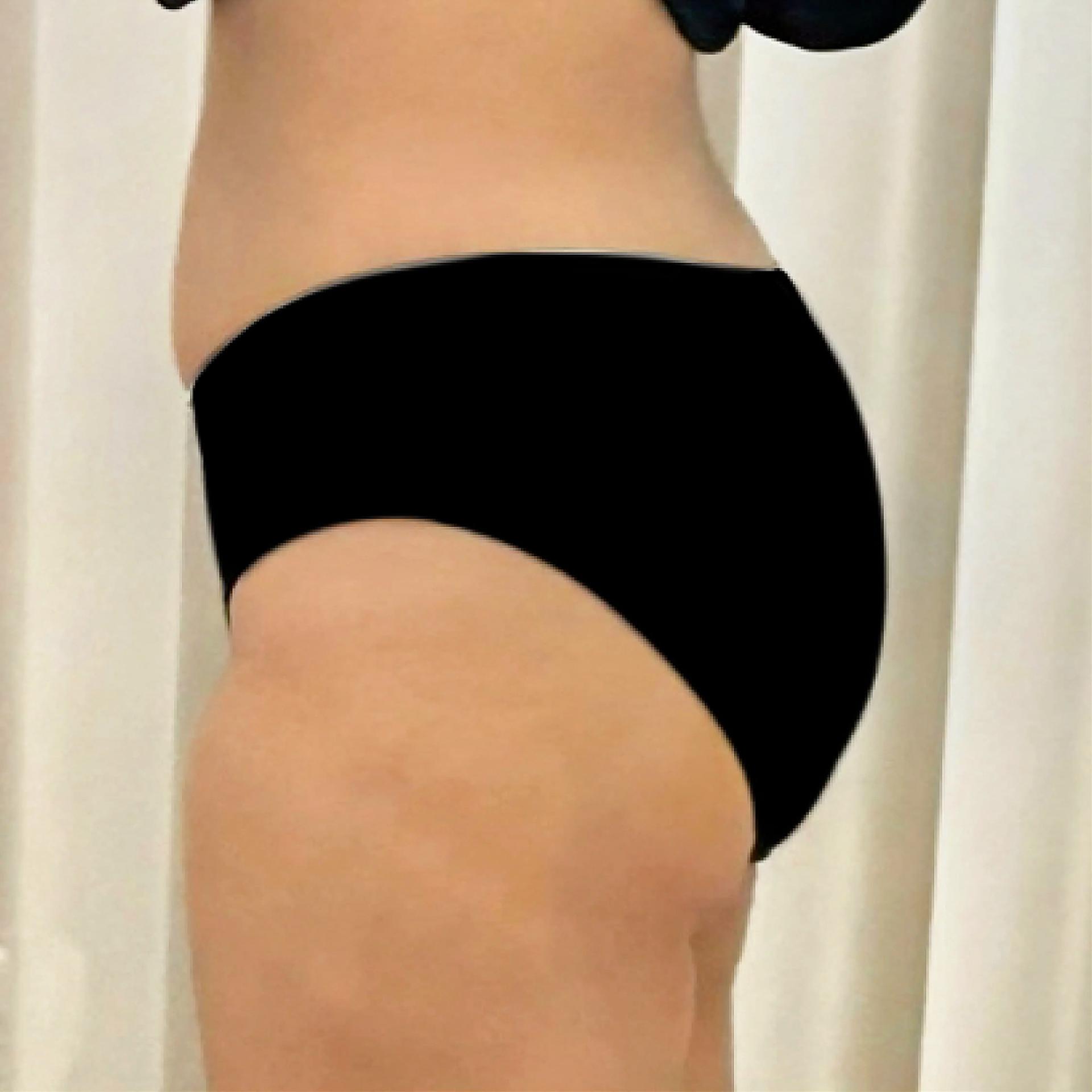 3 Months After Hip Up LAMS