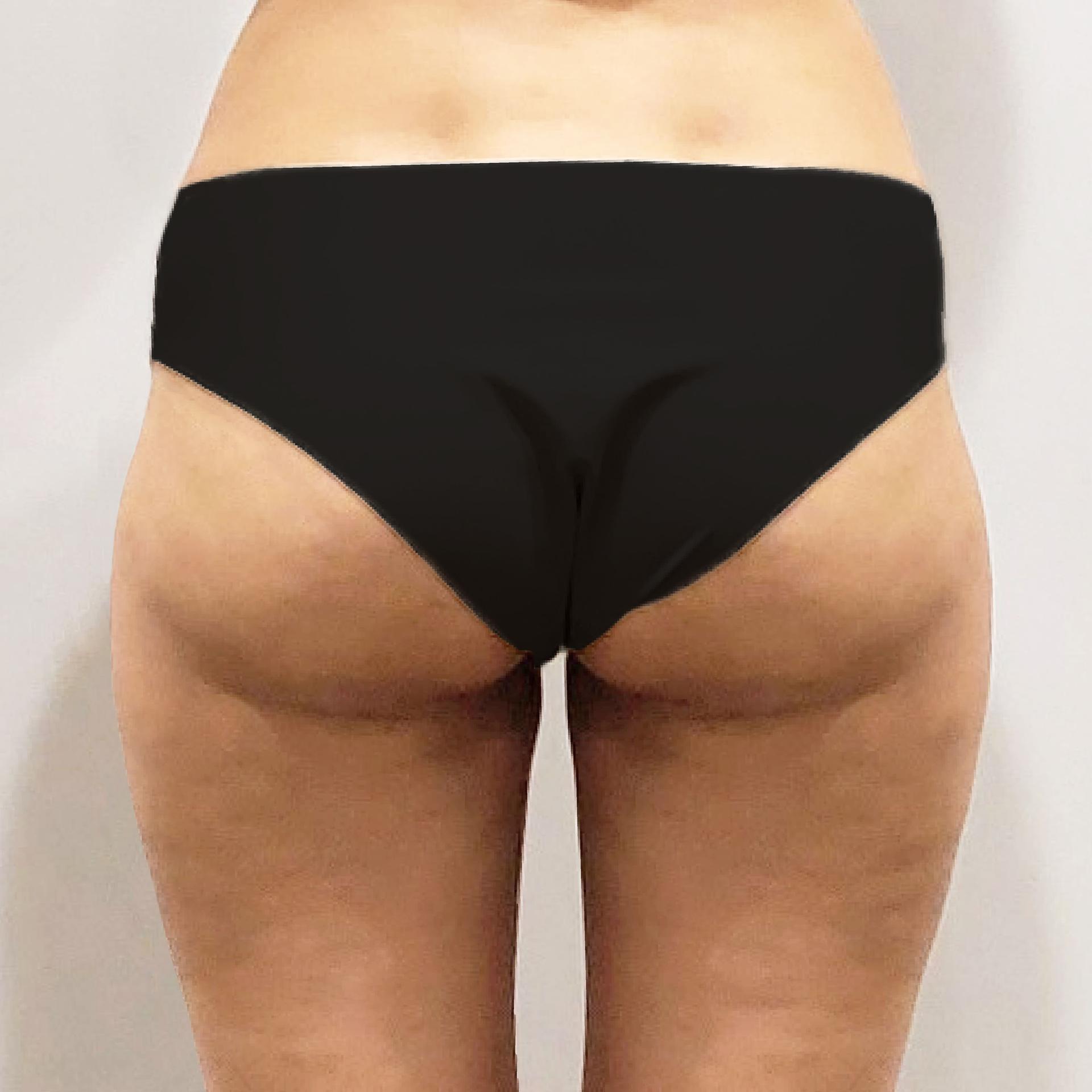 3 Months After Hip Up LAMS