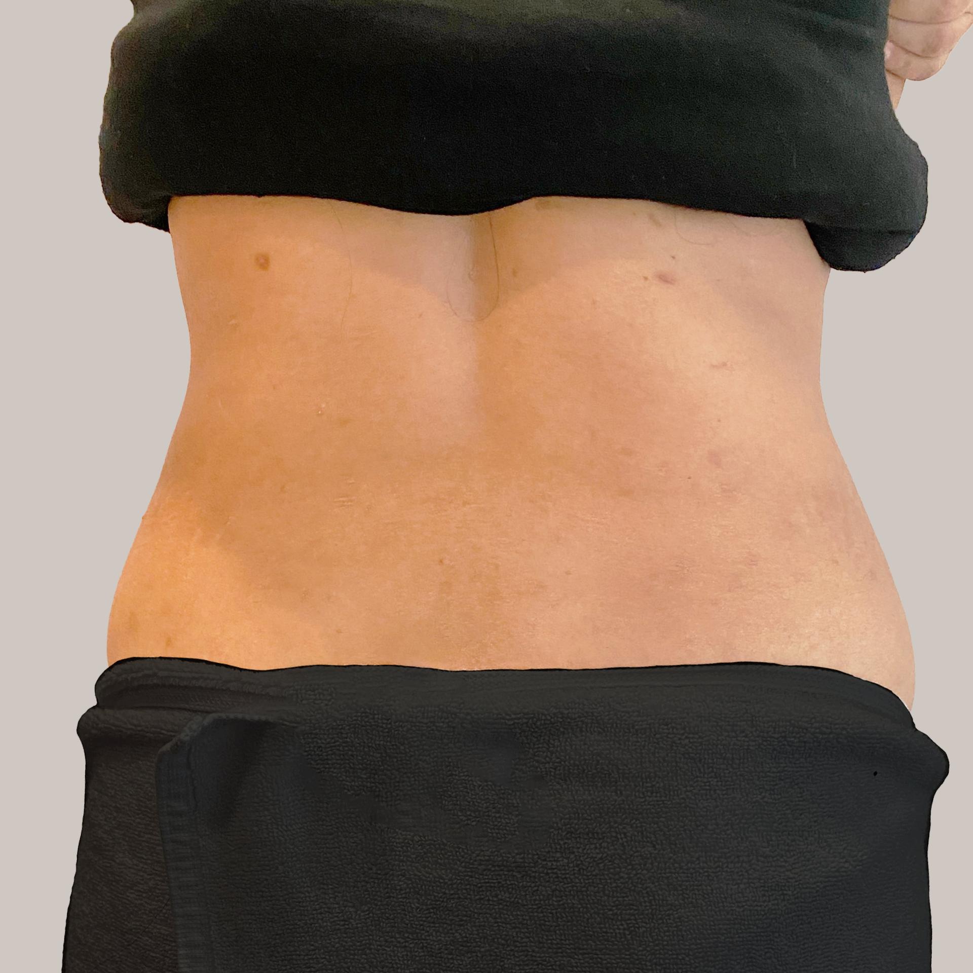 6 month after LAMS