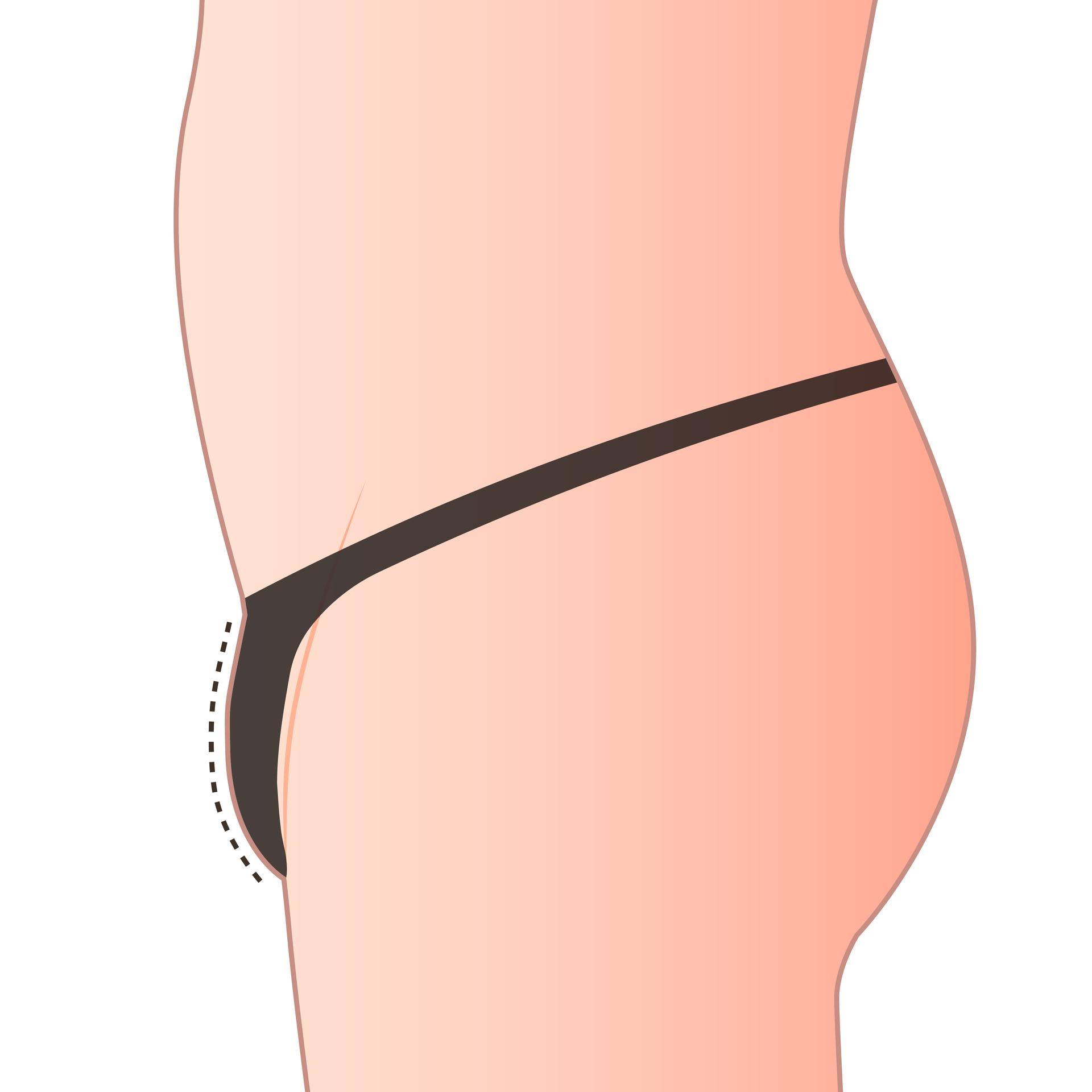 Before Mons Pubis LAMS
