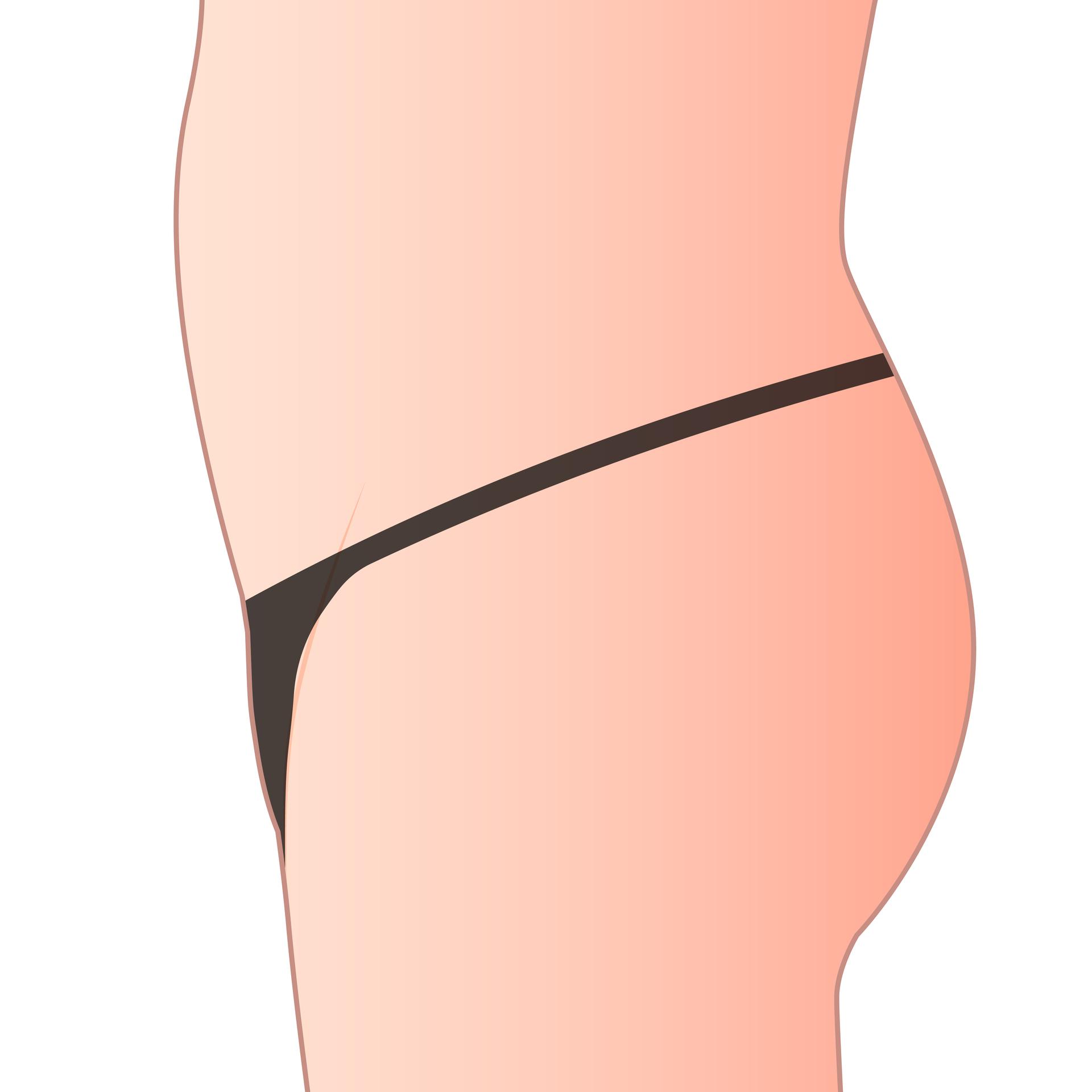 3 Months After Mons Pubis LAMS