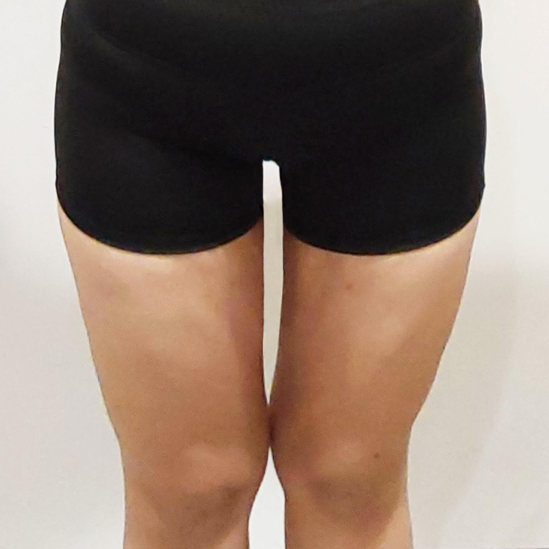 3 Months After Thighs LAMS