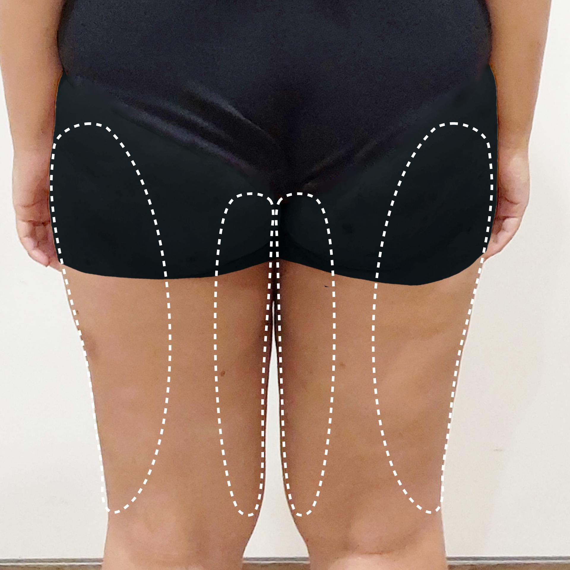 Before Thighs LAMS