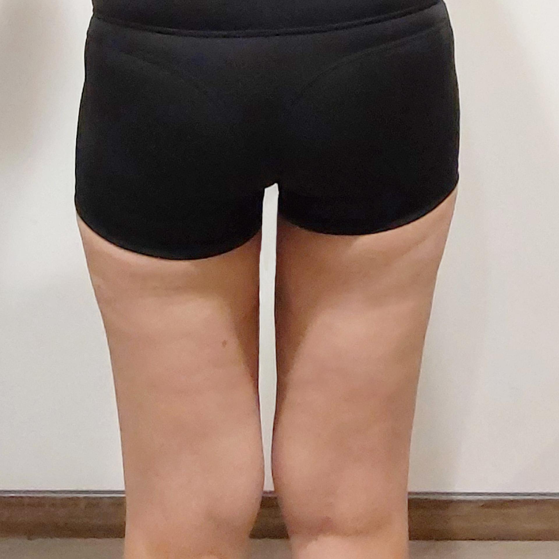 3 Months After Thighs LAMS